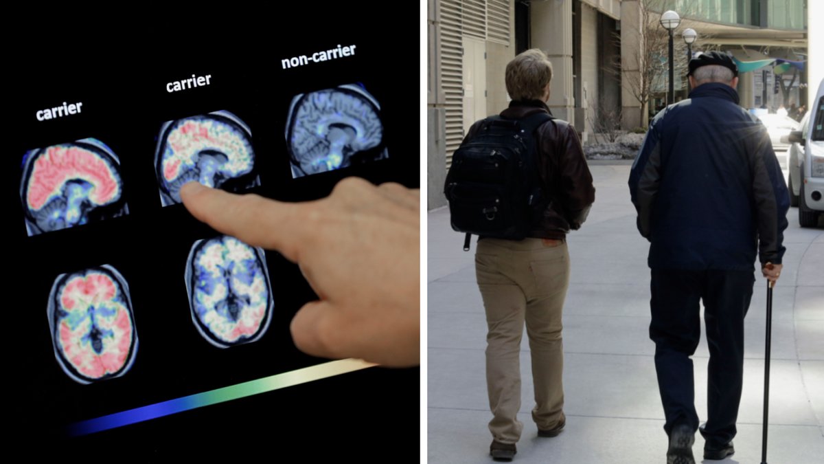 En ny studie avslöjar tidiga tecken på Alzheimers sjukdom.